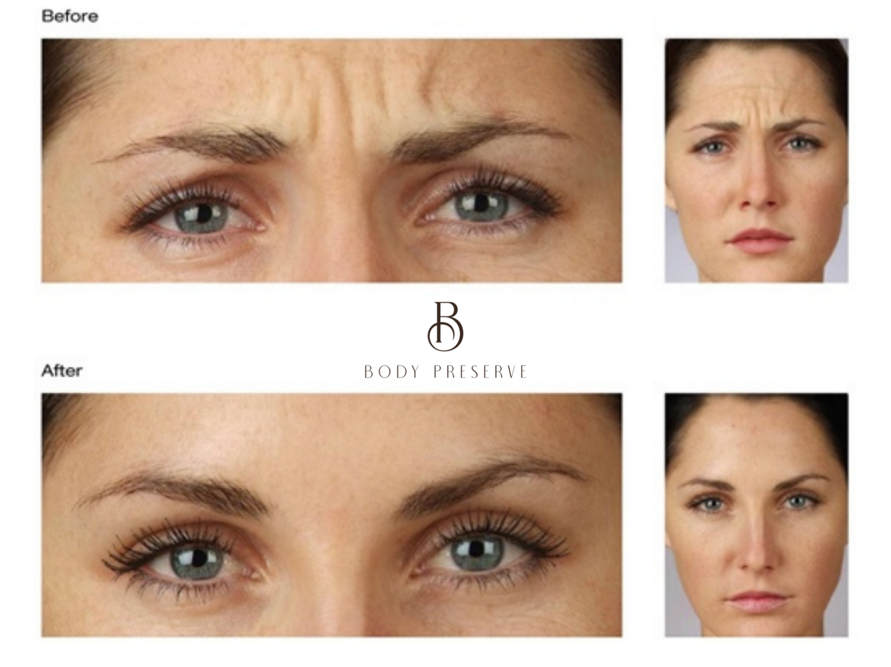 before and after Cosmetic injectables, Derma Fillers And Botox In Scottsdale AZ