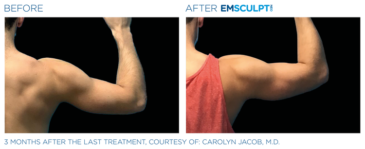 Before and after sculpting