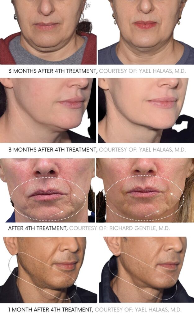 Before and after