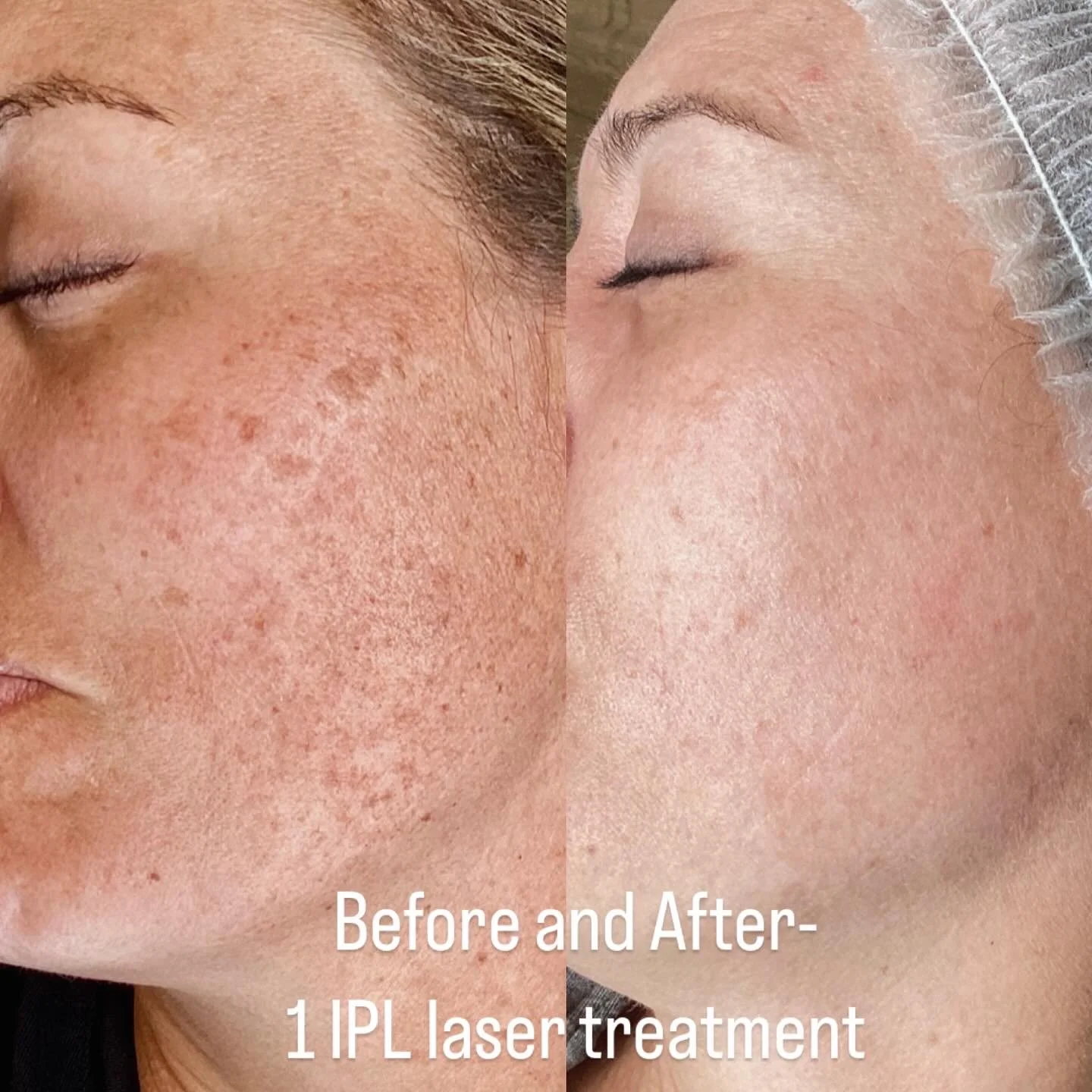Before and after Expert IPL Photofacial Treatments in Scottsdale & Near Phoenix