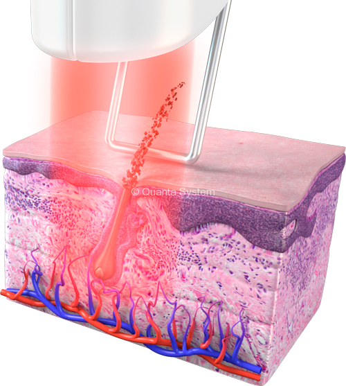 Professional Laser Hair Removal Treatments In Scottsdale Phoenix