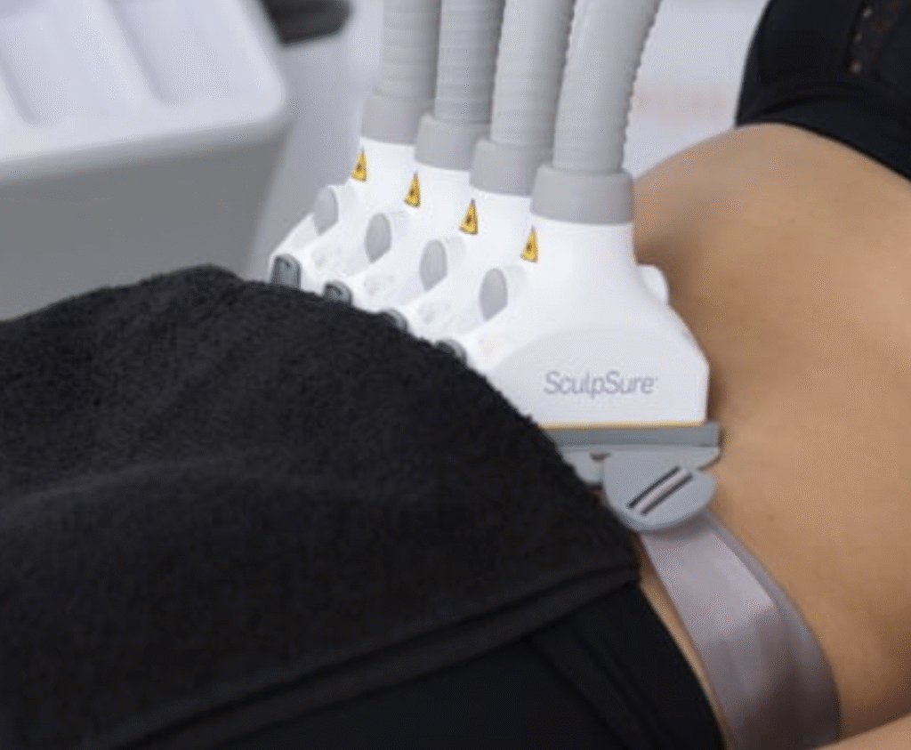 A close-up of a person's midsection undergoing a SculpSure Treatment, with four applicators placed on the skin and a black towel partially covering the area.