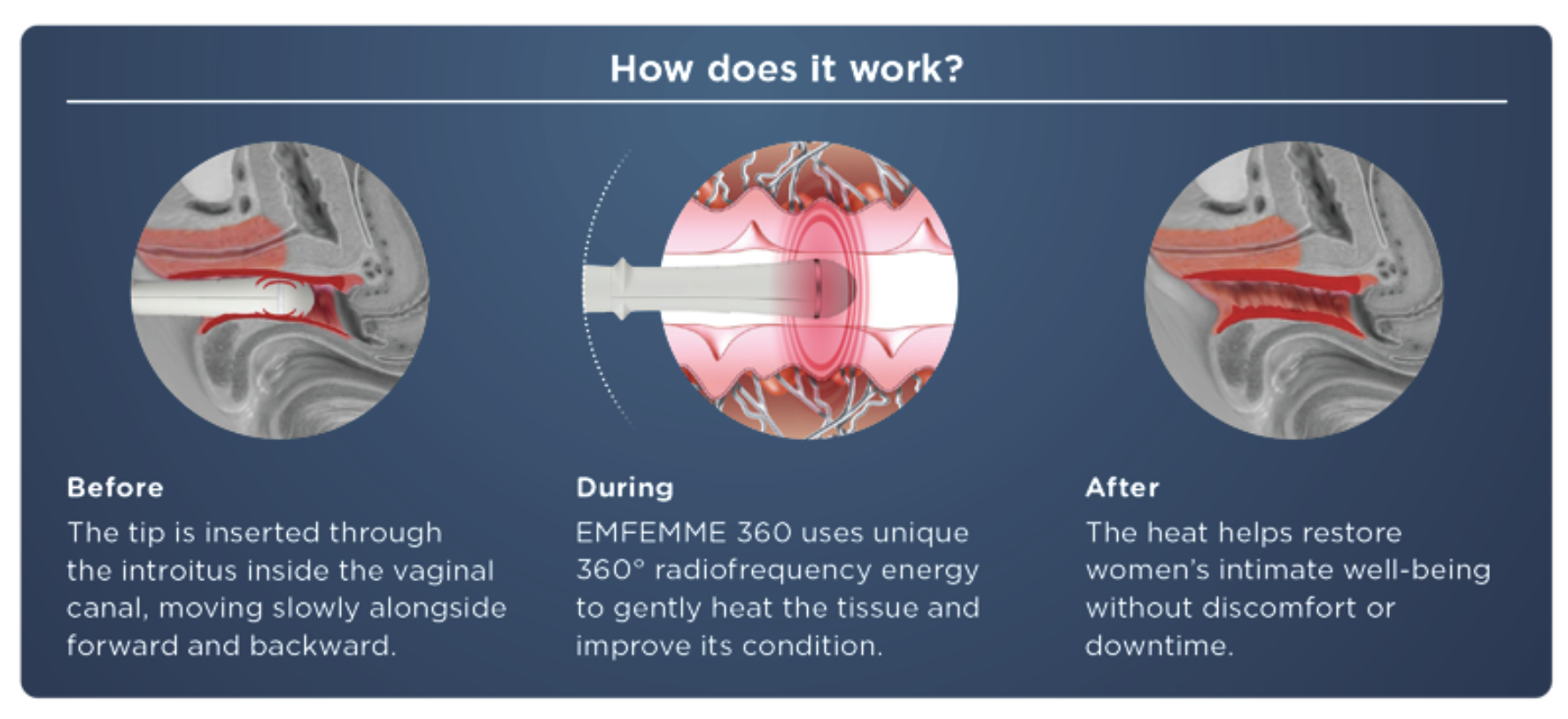 Emfemme 360 in Scottsdale for Vaginal Rejuvenation & Wellness