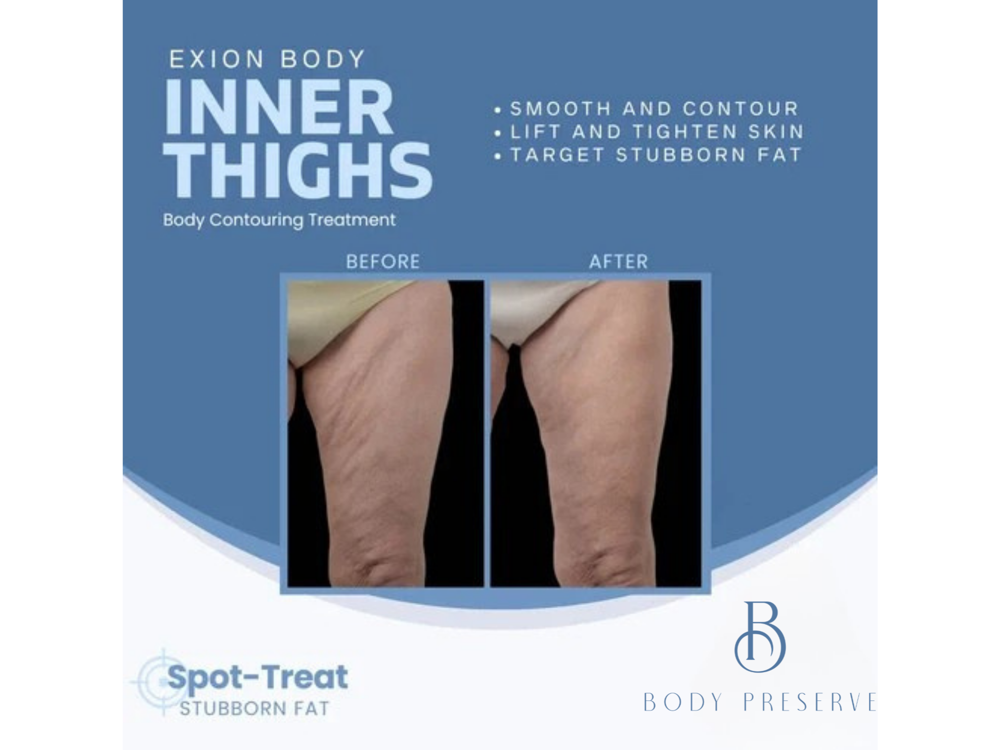 before and after Exion Body Sculpting Treatment in Scottsdale & Phoenix, AZ