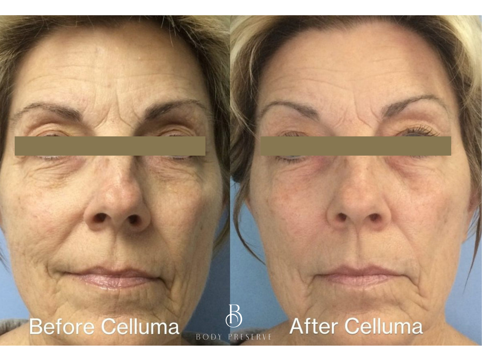 Before and after Celluma LED Light Therapy in Scottsdale Arizona | Non-Invasive