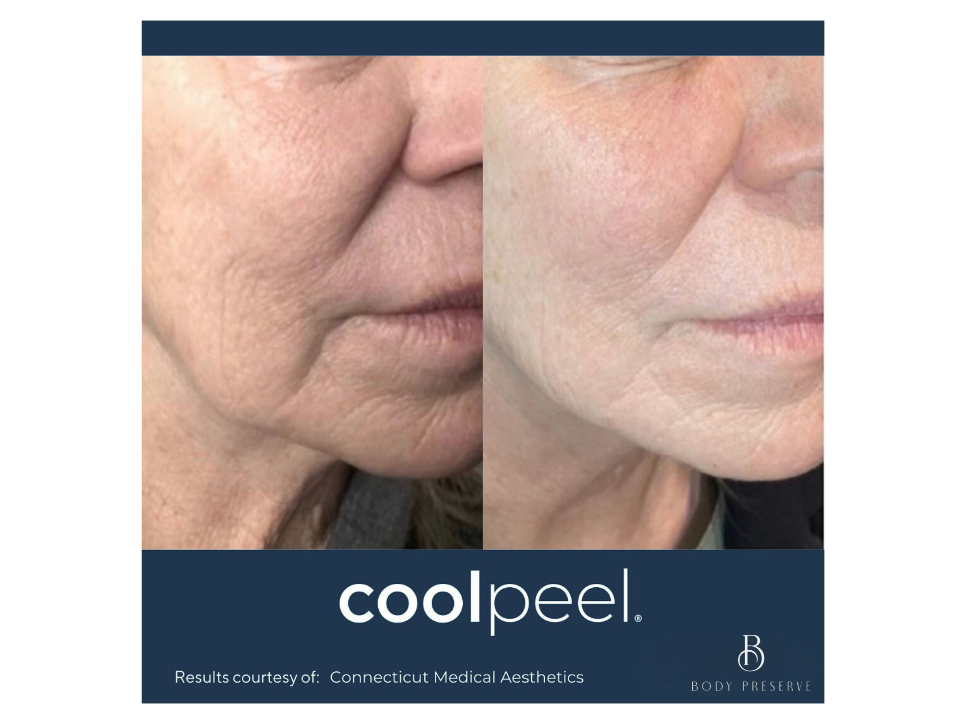 Before and after CO2 CoolPeel Laser Treatment Scottsdale & Phoenix | Clear Skin