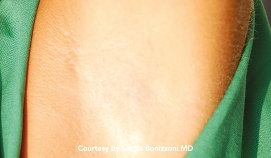 Before and after Laser Hair Removal Treatments In Scottsdale Phoenix