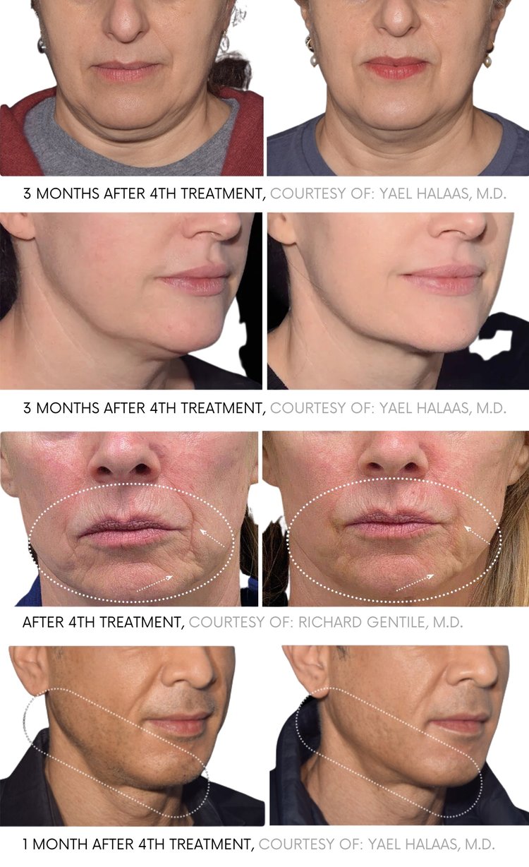 before and after Emface Treatment Scottsdale AZ | Safe, Non-Invasive Skin Lift
