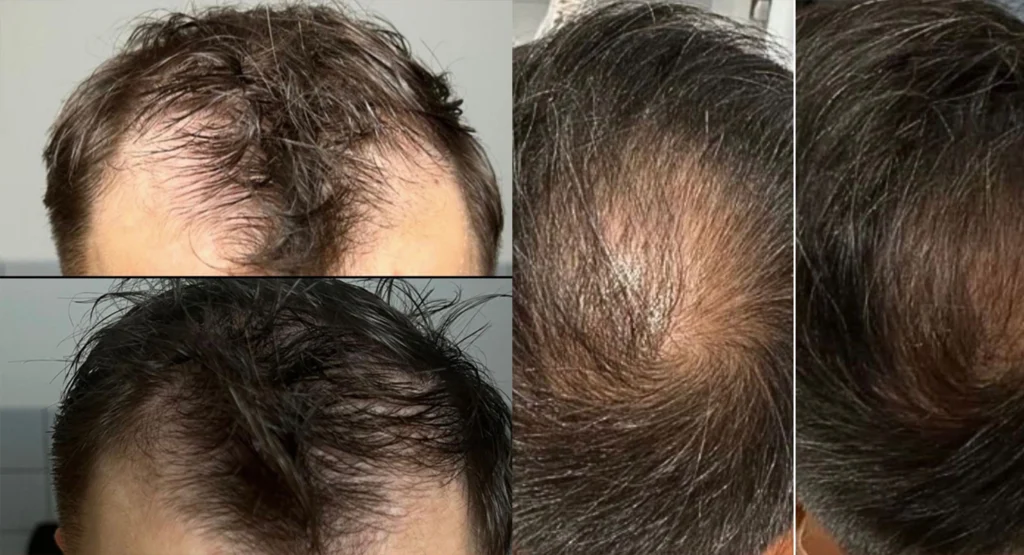 before and after Exion Microneedling & Exosome Therapy for Hair Loss Scottsdale