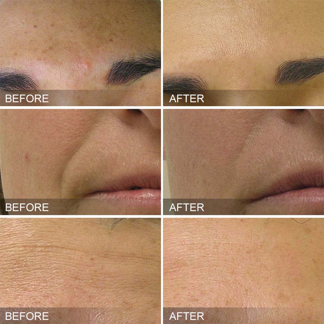 before and after Hydrafacial Treatment in Scottsdale | Smooth, Radiant Skin