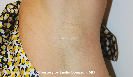 Before and after Laser Hair Removal Treatments In Scottsdale Phoenix