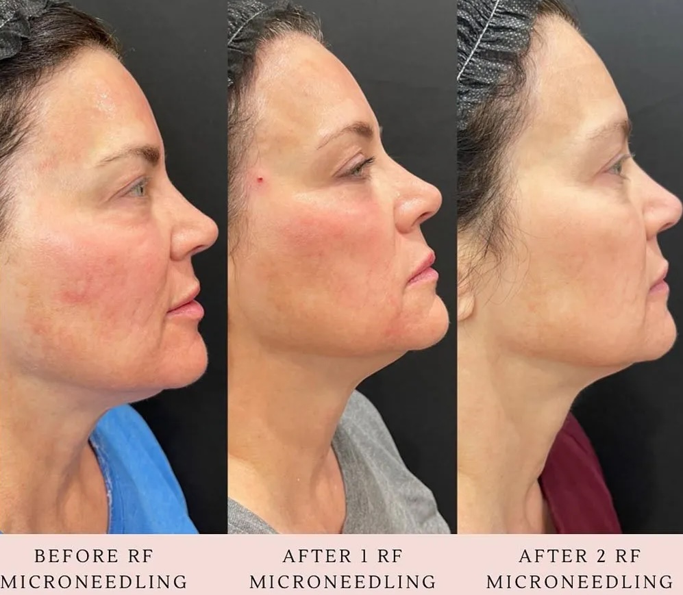 Beforre and after RF Microneedling in Scottsdale & Phoenix, AZ for Smooth Skin