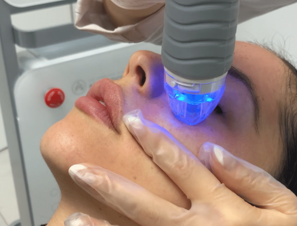 RF Microneedling in Scottsdale & Phoenix, AZ for Smooth Skin