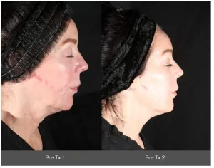 Side-by-side profile photos of a woman before and after a Xerf Treatment, showing reduced redness and a more defined jawline in the second image. Pre Tx 1 and Pre Tx 2 labels appear below each image.