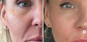 Side-by-side close-up of a woman's face before and after a Xerf Treatment, showing reduced wrinkles and smoother skin in the after image.
