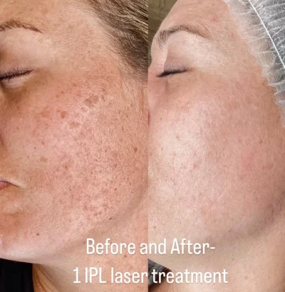 IPL Before and after Expert IPL Photofacial Treatments in Scottsdale & Near Phoenix